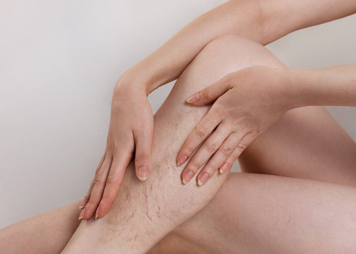 Cách điều trị suy giãn tĩnh mạch