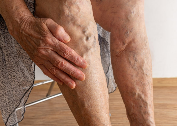 Giải pháp giảm suy giãn tĩnh mạch