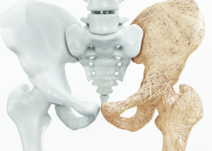 Bệnh loãng xương ở người già