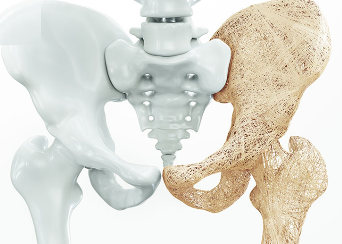 Bệnh loãng xương ở người già