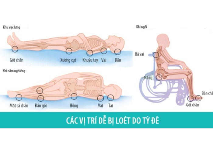 Cách chống loét da cho người liệt