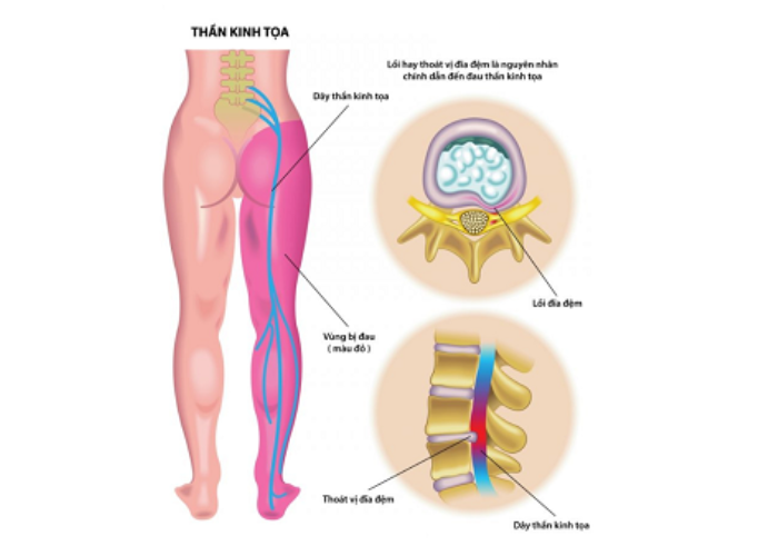 Đau thần kinh tọa