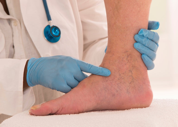 Điều trị giãn mao mạch mặt_chân