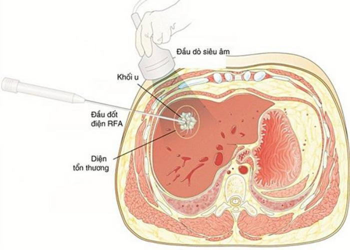 Đốt sóng cao tần RFA