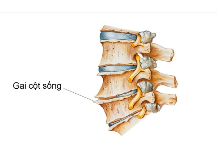 Gai cột sống thắt lưng