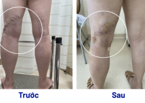 Keo sinh học VenaSeal