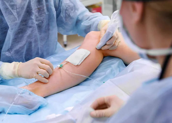 Laser nội mạch (EVLA)