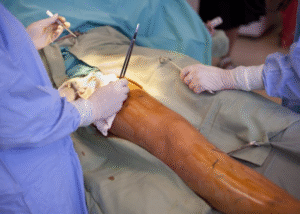 Phẫu thuật Stripping (Rút bỏ tĩnh mạch)