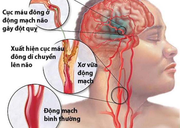 Tai biến mạch máu não ở người già