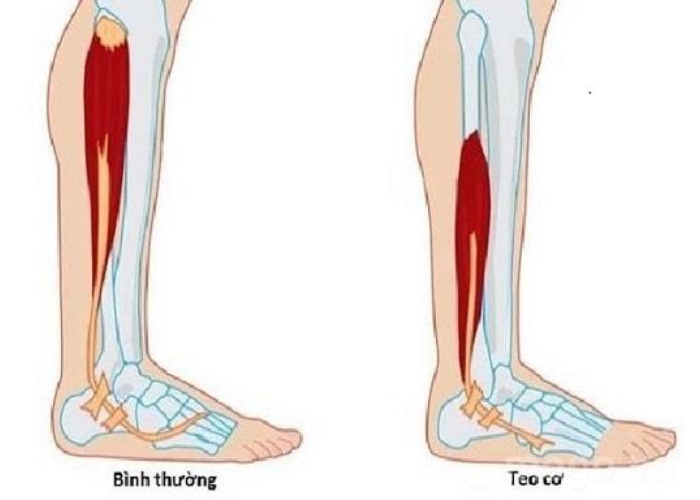 Tập vận động cho người bị teo cơ cứng khớp 