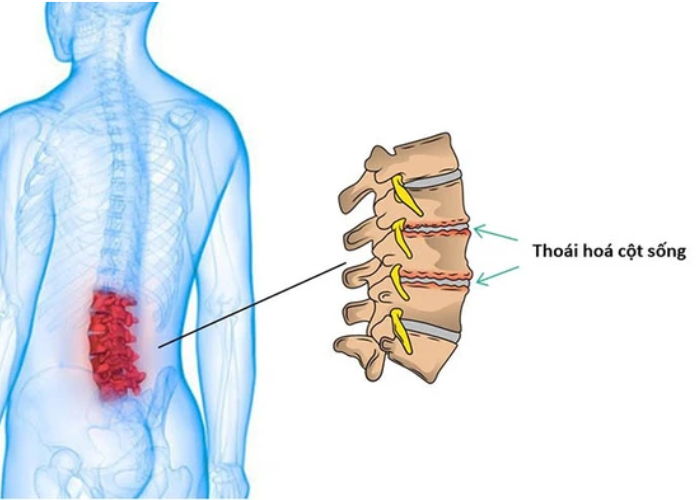 Thoái hóa cột sống thắt lưng