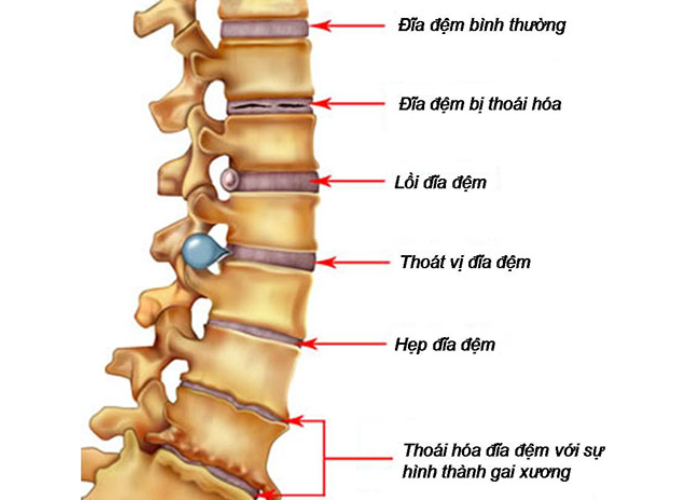 Thoái hóa cột sống thắt lưng