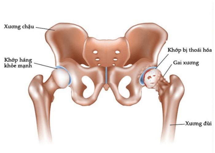 Thoái hóa khớp háng ở người già 