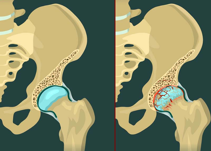 Thoái hóa khớp háng ở người già
