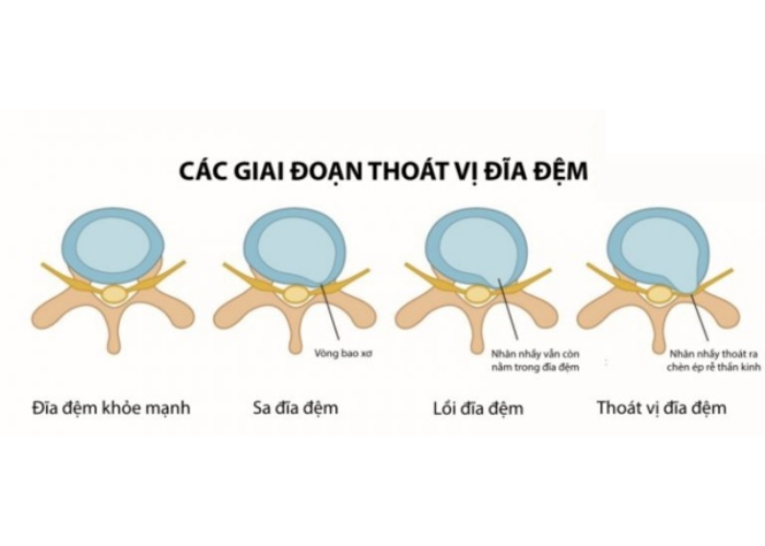 Thoát vị đĩa đệm cột sống 