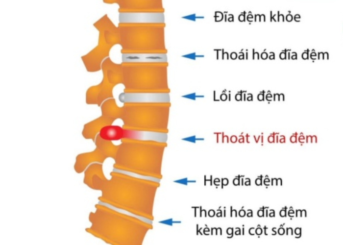Thoát vị đĩa đệm cột sống