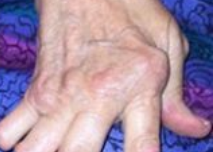 Viêm khớp dạng thấp