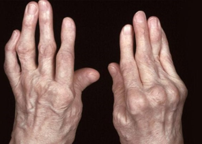 Viêm khớp dạng thấp