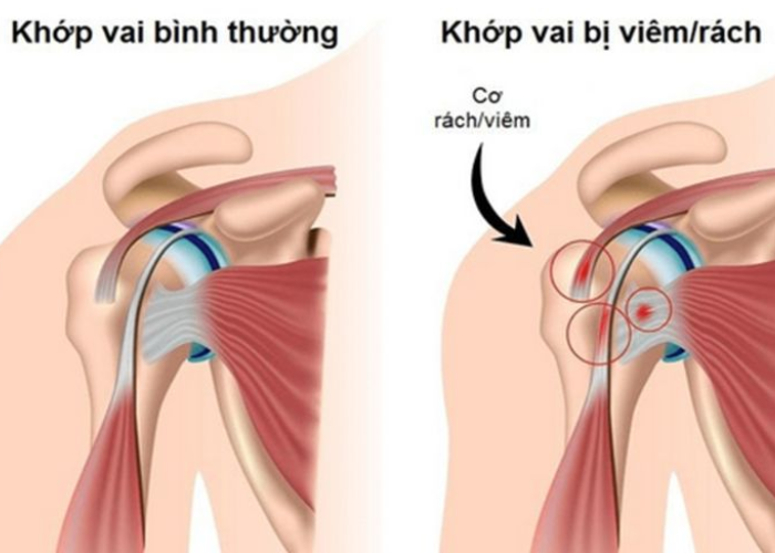Viêm quanh khớp vai