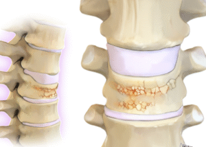 Xẹp đốt sống do loãng xương