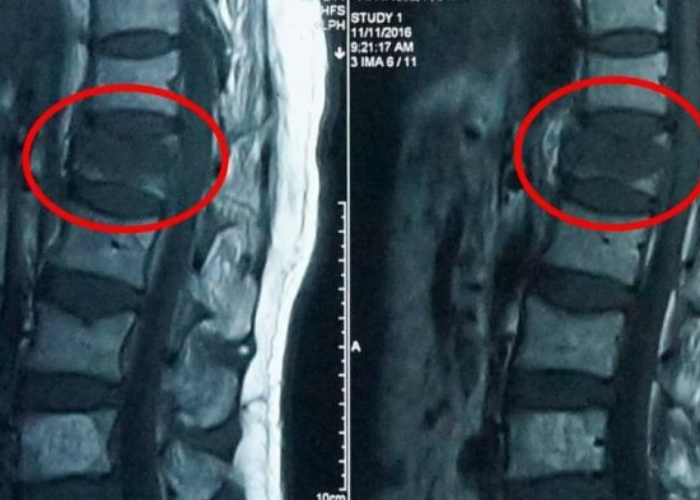 Xẹp đốt sống do loãng xương