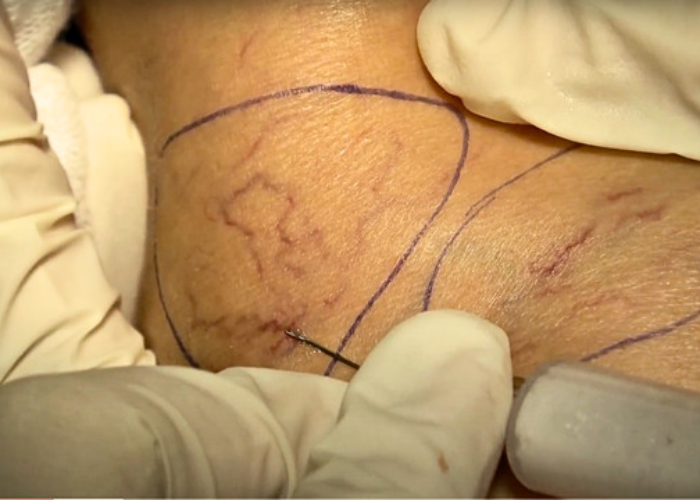 tiêm xơ tĩnh mạch (chích xơ)