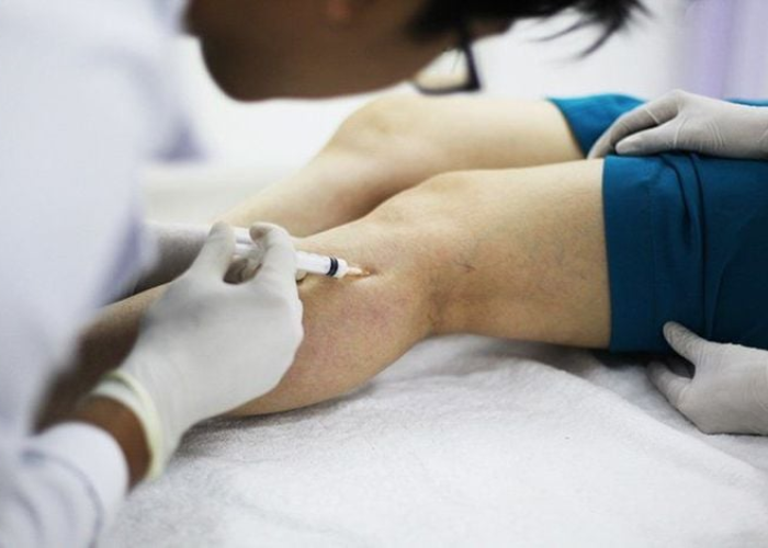 tiêm xơ tĩnh mạch (chích xơ) 