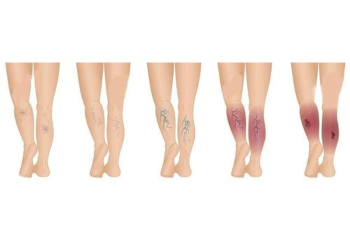 Biến chứng nguy hiểm của suy giãn tĩnh mạch chi dưới