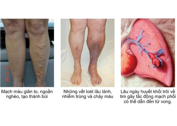Biến chứng nguy hiểm của suy giãn tĩnh mạch chi dưới 