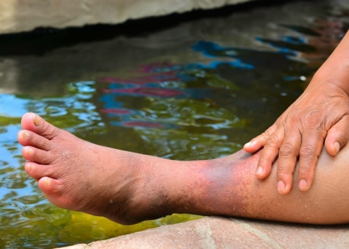 Biến chứng nguy hiểm của suy giãn tĩnh mạch chi dưới