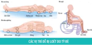 Cách phòng ngừa loét tì đè cho bệnh nhân nằm lâu