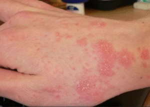 Chàm da do ứ trệ tĩnh mạch