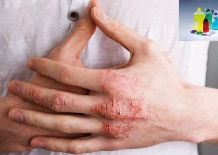 Chàm da do ứ trệ tĩnh mạch