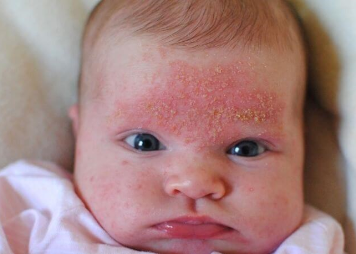 Chàm da do ứ trệ tĩnh mạch 