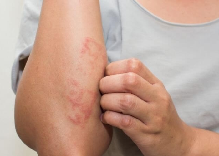 Chàm da do ứ trệ tĩnh mạch