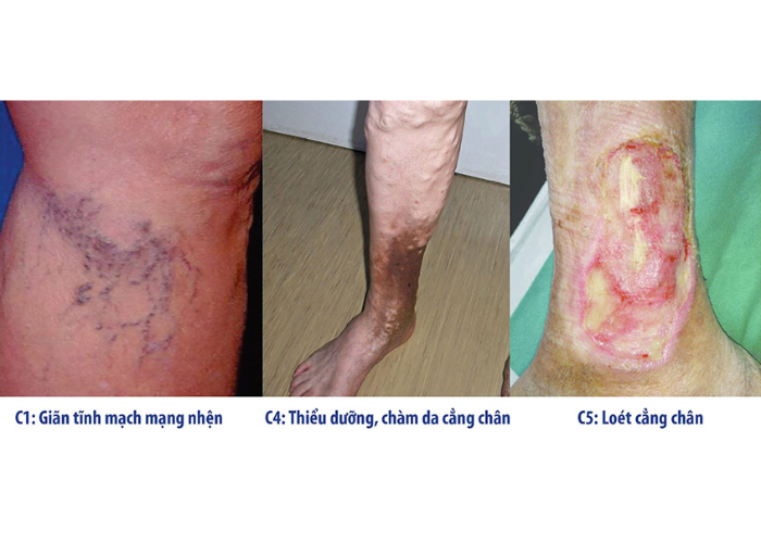 Chăm sóc bệnh suy tĩnh mạch chi dưới 