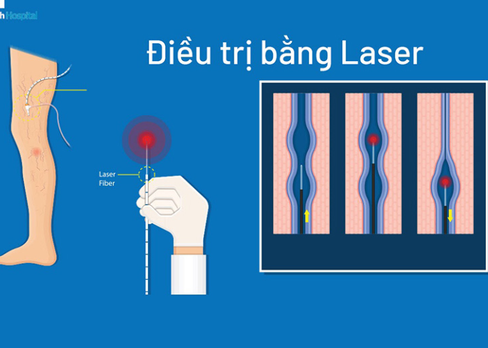 Chăm sóc bệnh suy tĩnh mạch chi dưới 