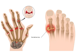 Chế độ ăn uống cho người bệnh gút