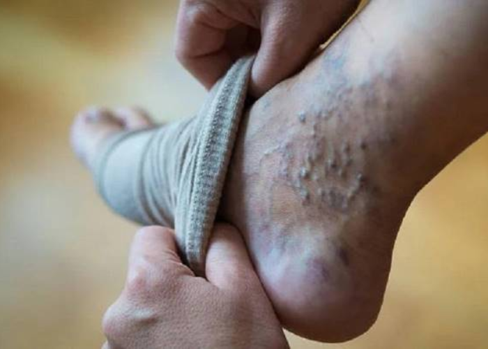 Đai quấn giãn tĩnh mạch