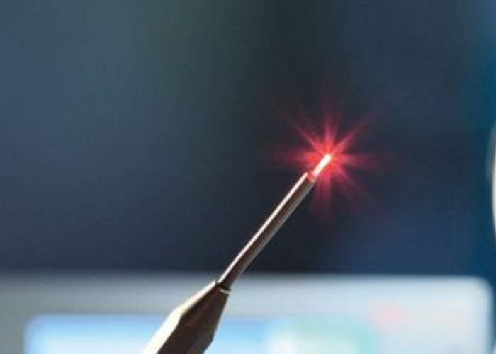 Điều trị suy giãn tĩnh mạch bằng laser nội mạch EVLA 