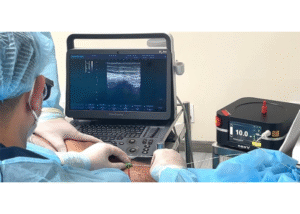 Điều trị suy giãn tĩnh mạch bằng laser nội mạch EVLA (3)