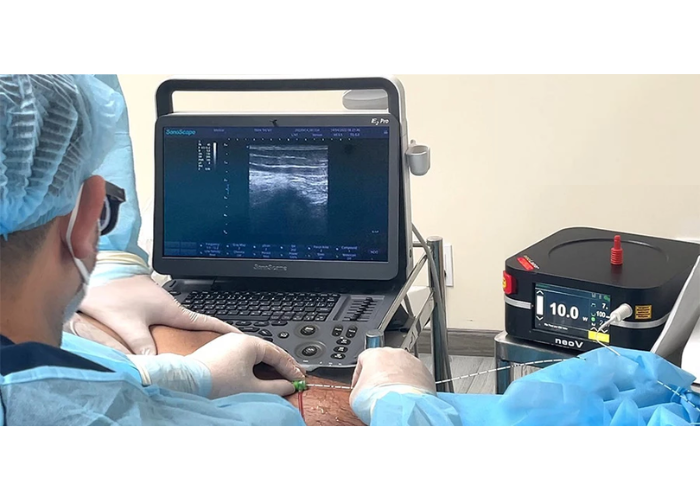 Điều trị suy giãn tĩnh mạch bằng laser nội mạch EVLA (3)