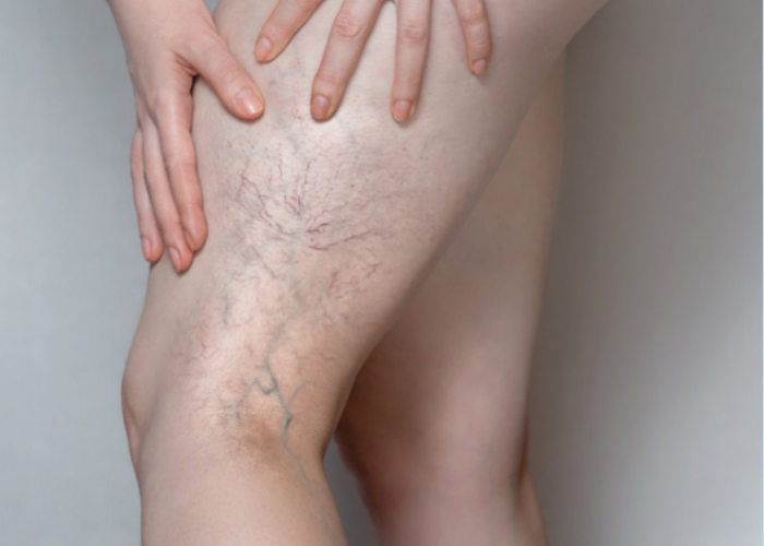 Huyết khối tĩnh mạch sâu (DVT)