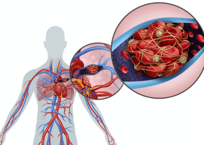 Huyết khối tĩnh mạch sâu (DVT)