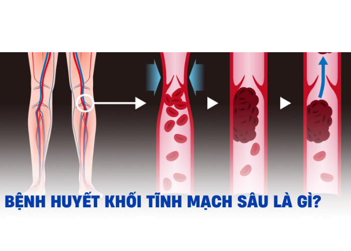 Huyết khối tĩnh mạch sâu (DVT)
