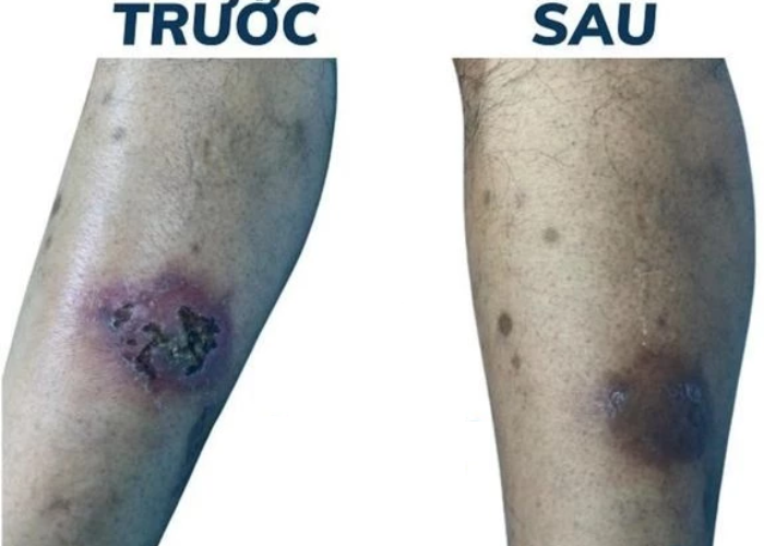 Loét chân do dinh dưỡng tĩnh mạch 