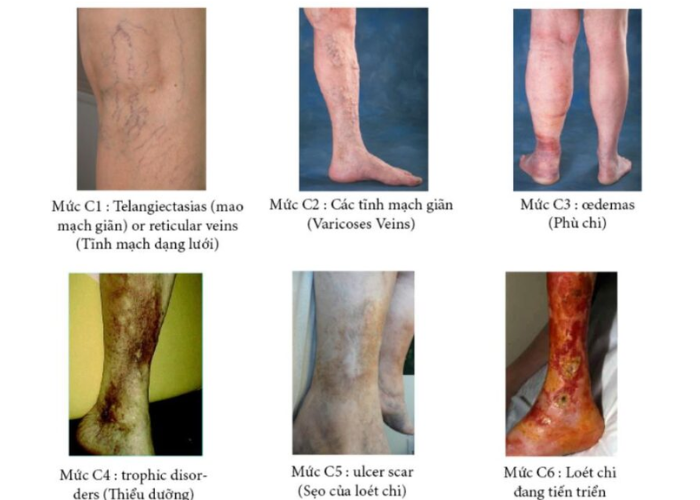 Loét chân do dinh dưỡng tĩnh mạch