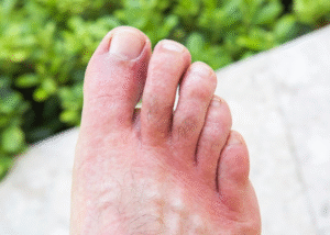 Ngứa vùng da chân do ứ máu