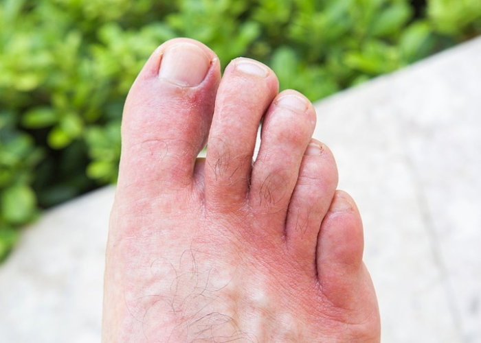 Ngứa vùng da chân do ứ máu 