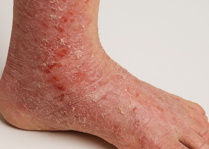 Ngứa vùng da chân do ứ máu 